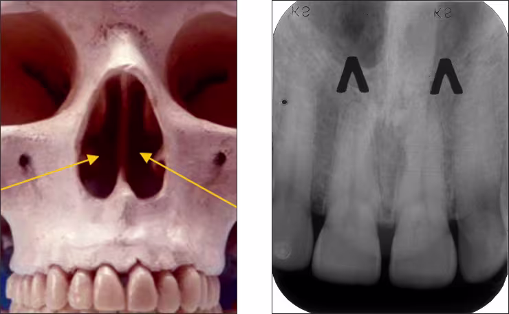 Maxillary Anterior Landmarks - Figure 1