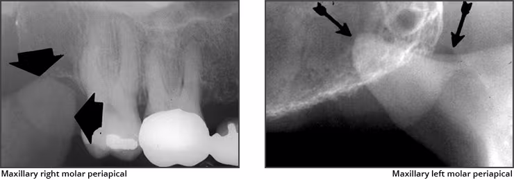 Maxillary Posterior Landmarks - Figure 5