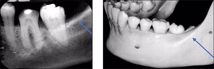 Mandibular Posterior Landmarks - Figure 2