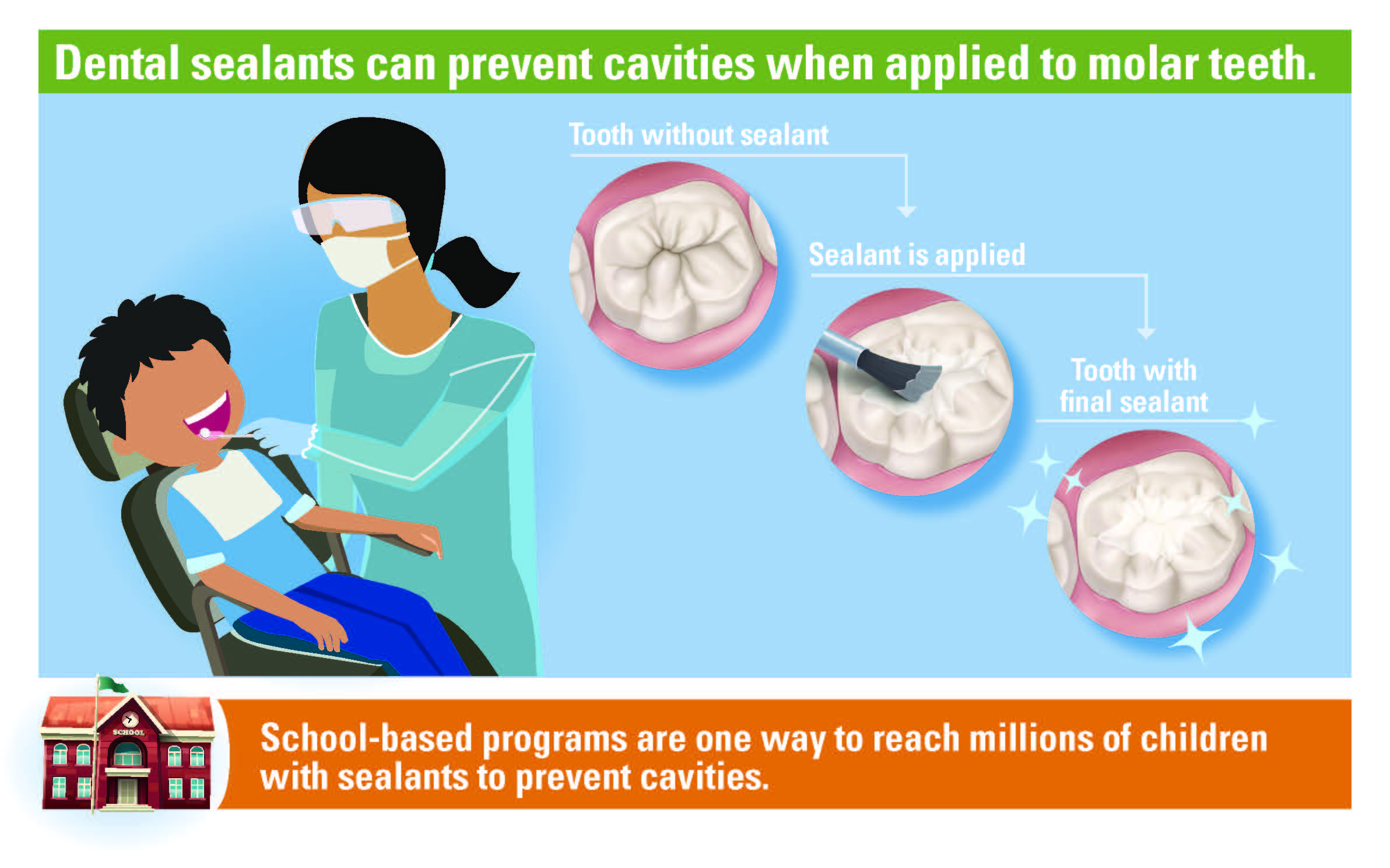 Dental Sealants Dental Sealants