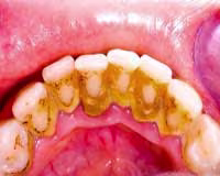 Heavy Dental Calculus 2