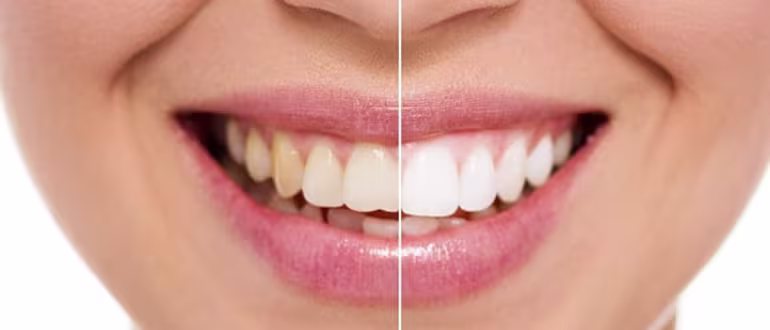 Whitening Image